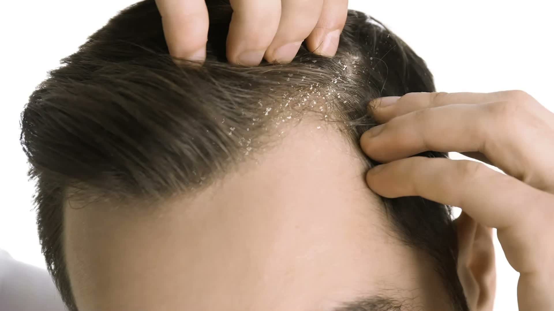Hair loss