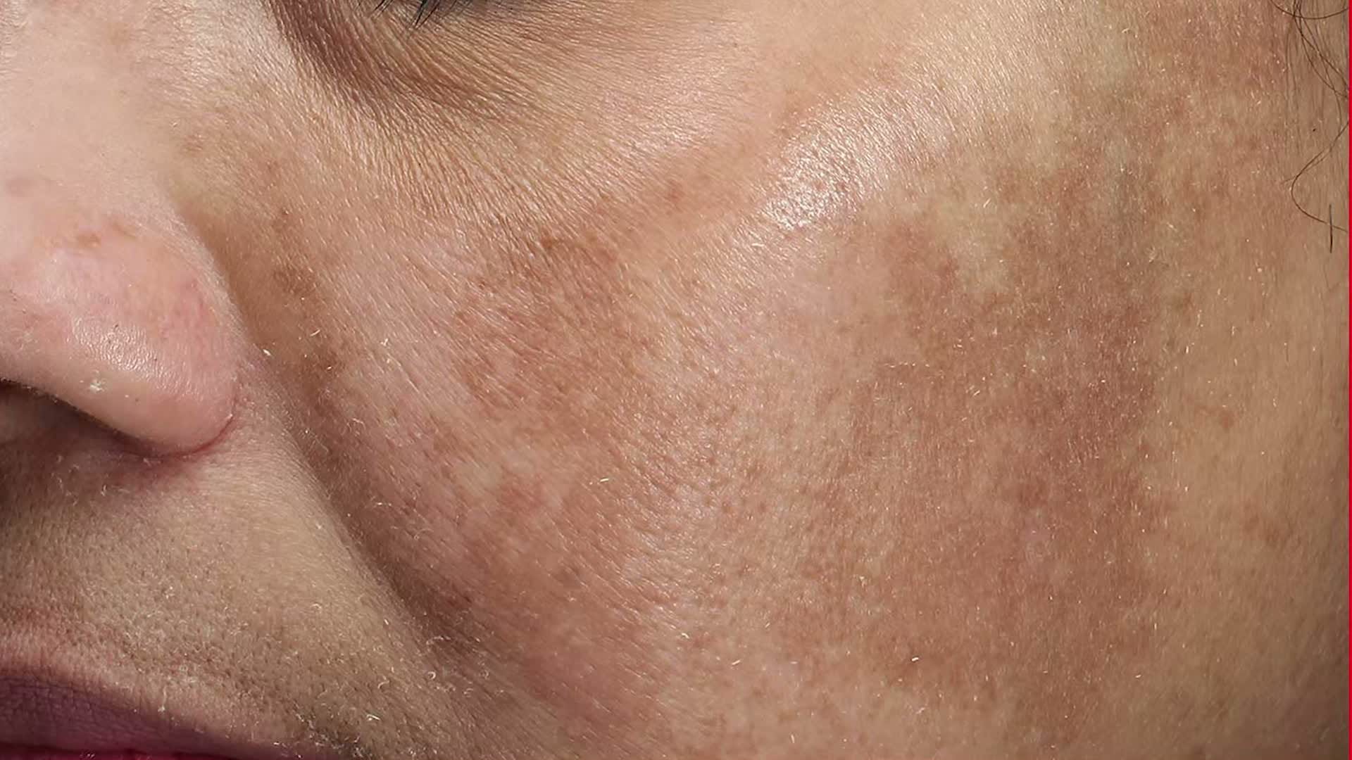 Skin spots / skin patches