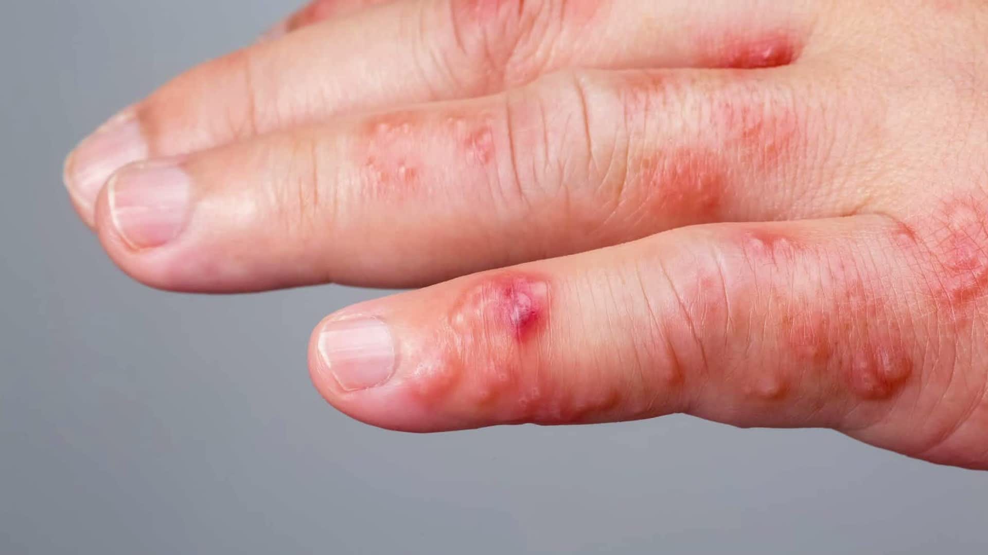 What is irritation